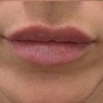 Lip Augmentation Before & After Patient #1238