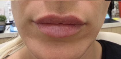 Lip Augmentation Before & After Patient #1238