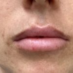 Filler Before & After Patient #1240
