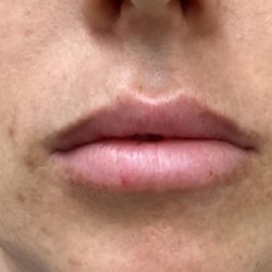 Filler Before & After Patient #1240