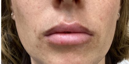 Filler Before & After Patient #1240