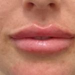 Filler Before & After Patient #1240