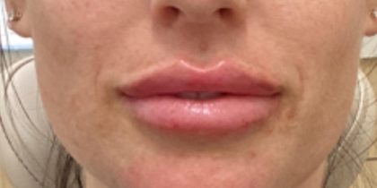 Filler Before & After Patient #1240