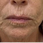 Filler Before & After Patient #1227