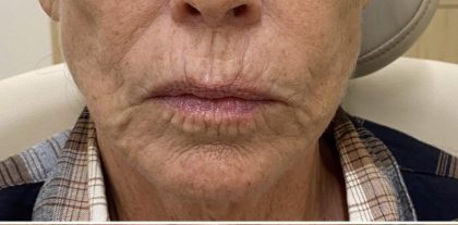 Filler Before & After Patient #1227
