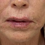 Filler Before & After Patient #1227