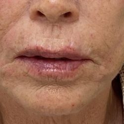 Filler Before & After Patient #1227