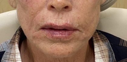 Filler Before & After Patient #1227