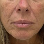 Filler Before & After Patient #1222