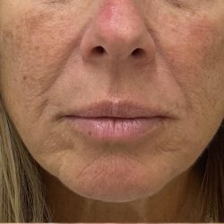 Filler Before & After Patient #1222