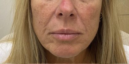 Filler Before & After Patient #1222