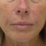 Filler Before & After Patient #1222