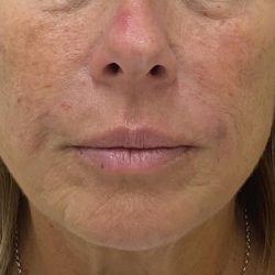 Filler Before & After Patient #1222