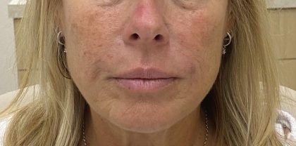 Filler Before & After Patient #1222