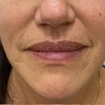 Filler Before & After Patient #1224