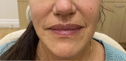 Filler Before & After Patient #1224