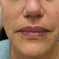 Filler Before & After Patient #1224