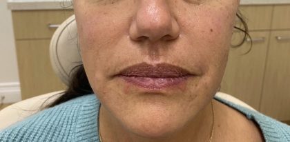 Filler Before & After Patient #1224