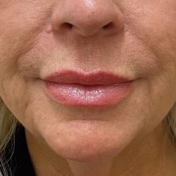 Filler Before & After Patient #1218