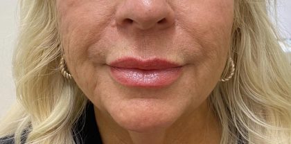 Filler Before & After Patient #1218