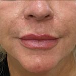Filler Before & After Patient #1218