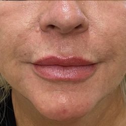Filler Before & After Patient #1218