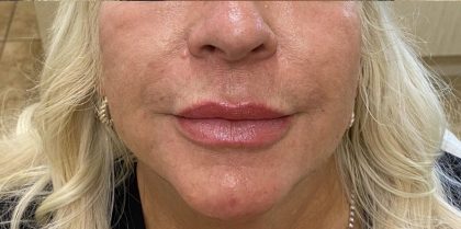 Filler Before & After Patient #1218